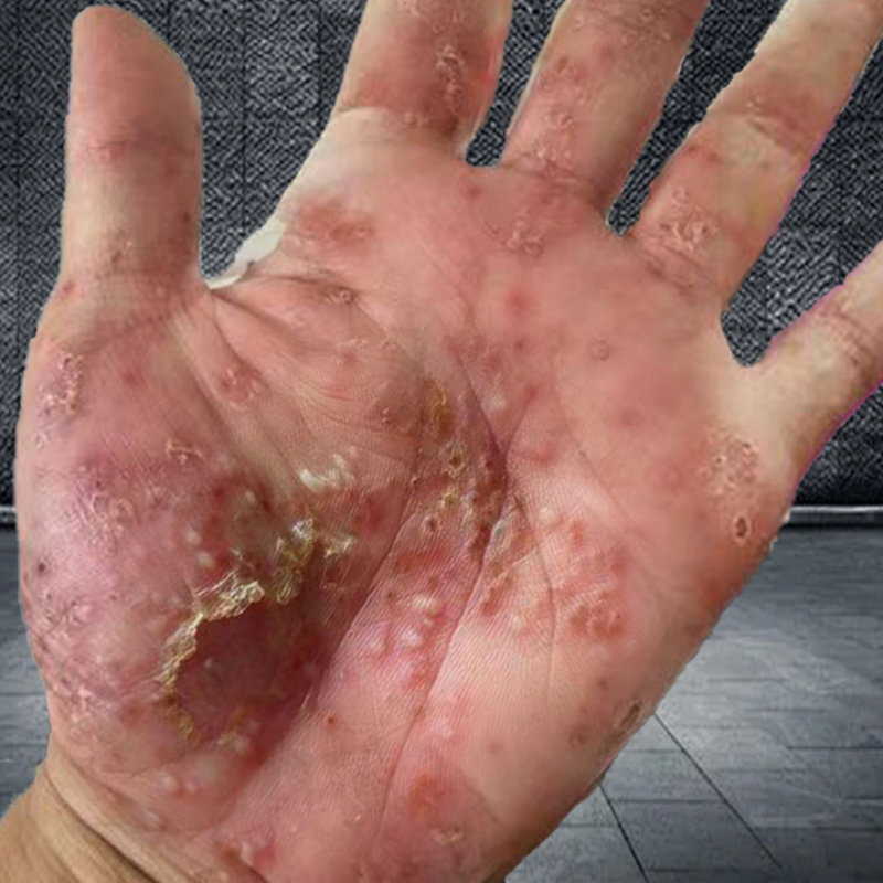 掌趾脓疱病症药治疗手脚脓包角化病蜕皮掌跖脓包红斑脱皮痒外用膏