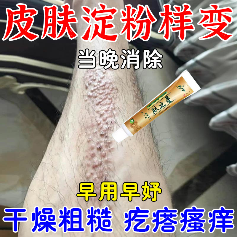 皮肤淀粉样变皮肤瘙痒止痒专用膏