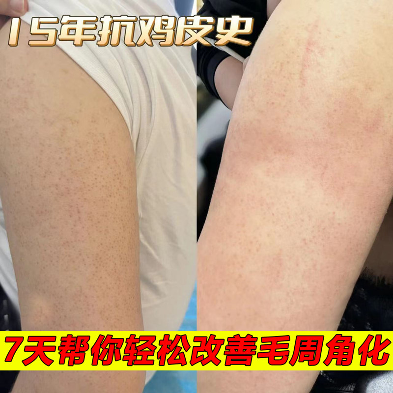鸡皮肤疙瘩毛囊角化去除神器角质毛周角化症鱼鳞皮肤霜克星病药膏