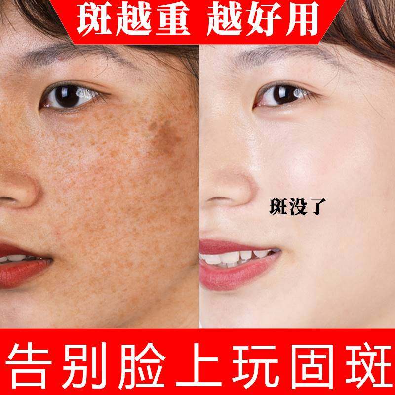 去除班黑斑老年色斑祛脸上黄褐斑点雀斑面部霜神器黑色素沉淀脸部