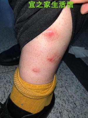 手上张藓牛皮癣仙云本草癣必净抑菌药膏植物草本护肤清痒20g皮廯