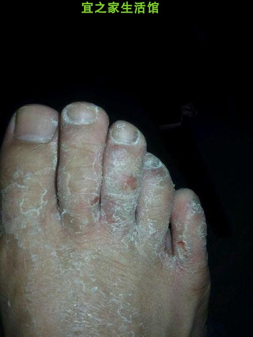 脚趾头痒脚气汉草民方草本药膏 皮肤止痒抑菌外用膏软膏江西慧广