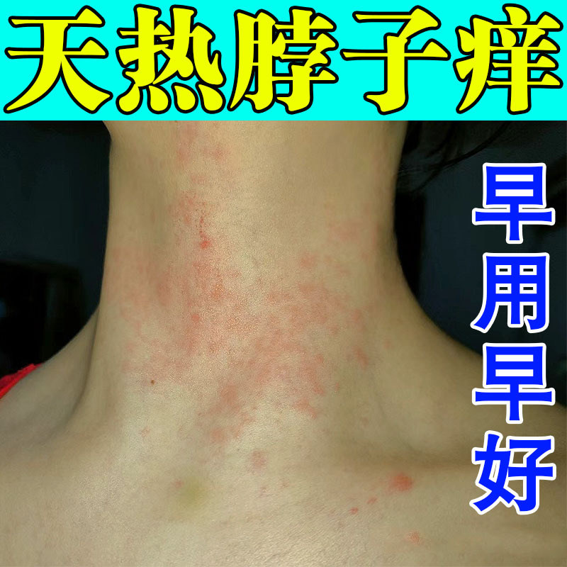夏天天热脖子皮肤痒刺挠起红点疙瘩颈部红痒过敏长痘痘止痒抑菌膏
