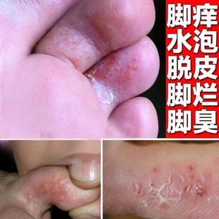 治疗脚痒脱皮杀糜烂真菌感染水泡脚痒烂脚丫香港脚脚趾缝溃烂膏药