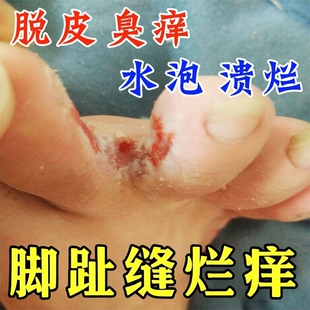 脚趾缝烂痒专用膏药脚痒脚出汗脚臭脚指间糜烂发白脱皮开裂起水泡