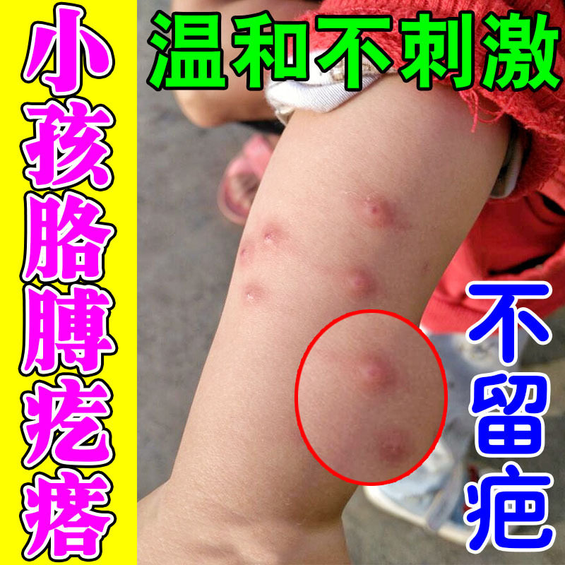 小孩全身上起红疙瘩痒儿童皮肤起皮肤消毒护理（消）