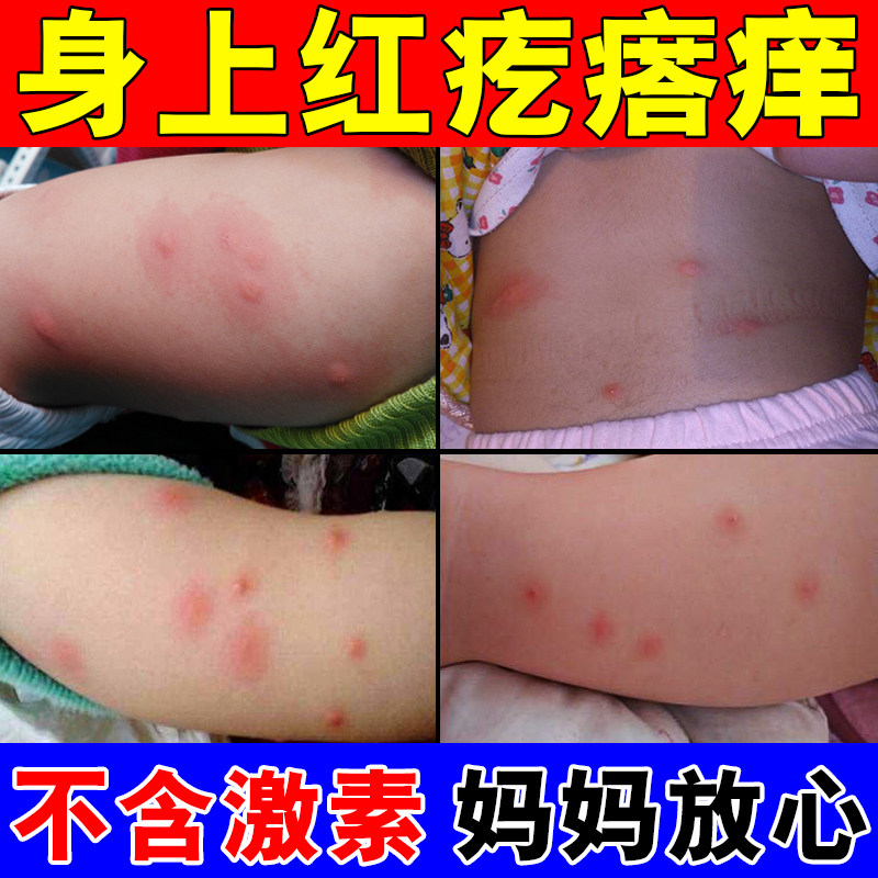 儿童皮肤痒喷剂身上起红疙瘩痒长小红点痘痘过敏发痒全身外用膏药