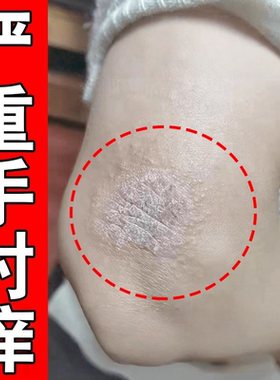手肘痒胳膊肘过敏湿痒干燥起皮发痒掉屑长鲜红斑红点疙瘩修复乳膏