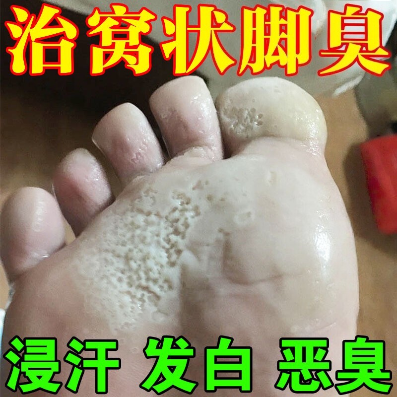 脚底蜂窝状沙虫脚起水泡脚底发白发臭窝状角质松解症脚痒脚臭专用