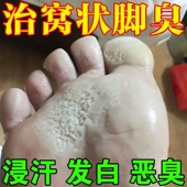 脚底蜂窝状沙虫脚起水泡脚底发白发臭窝状角质松解症脚痒脚臭专用