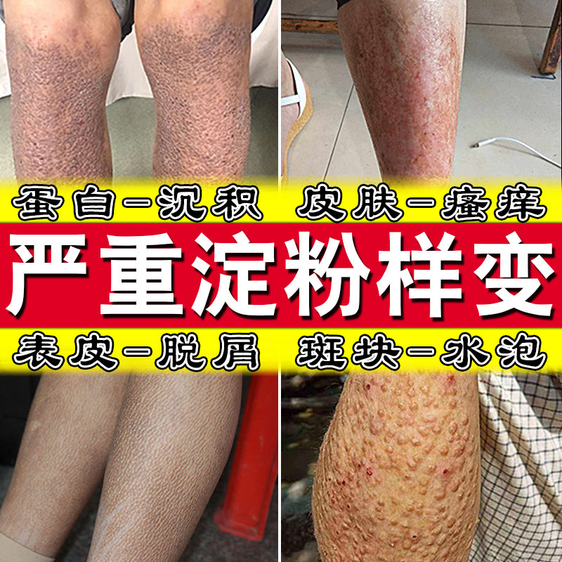 皮肤淀粉样变专药用治疗顽固皮痒小腿皮肤粗糙脱屑斑状凸起止痒膏