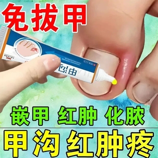 甲沟肿治疗专药用息肉嵌甲去除脚趾甲往肉里长红肿化脓消肿抑菌膏