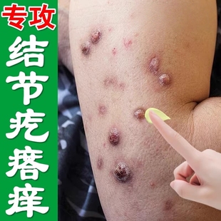 结节性痒疹特效治顽固硬疙瘩皮肤发痒身上起红斑湿痒外用修复乳膏