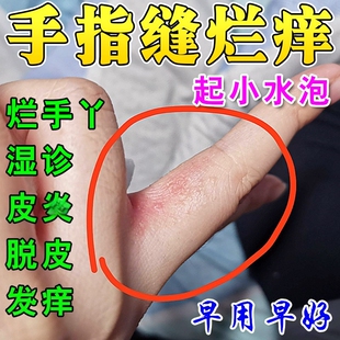 烂手丫外用膏药手指缝溃烂手痒脱皮干裂手指缝长小水泡痒修复软膏