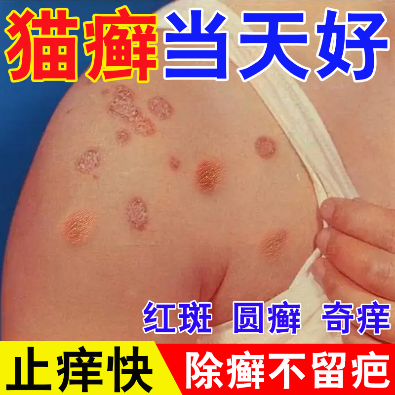 人用猫藓药猫藓外用人用猫癣专用人得猫癣皮肤病特效止痒人患药膏
