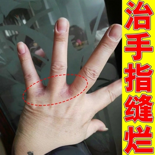 手指缝溃烂膏药烂手丫外用药治手脚痒真菌感染指缝糜烂脱皮修复膏