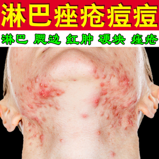 去淋巴腮边痘膏下巴痘痘淋巴长痘腮边长痘硬块痘痤疮青春痘修复膏
