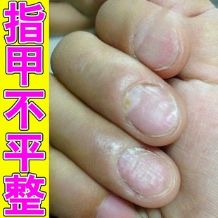 指甲不平凹陷药发黄增厚专用手脚指甲凹凸不平整竖纹甲床受损萎缩