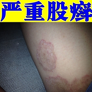 股藓大腿内侧真菌感染私处皮肤发痒屁股湿痒大腿两侧红痒专祛乳膏