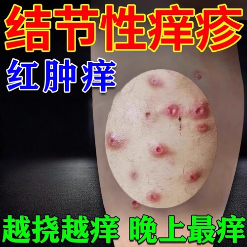 结节性痒疹特药效治全身皮肤长小红疙瘩小红点顽固红斑痒外用乳膏