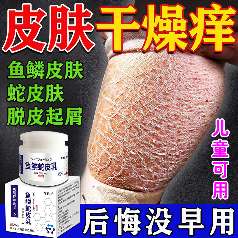 鱼鳞病皮肤霜专用膏去蛇皮肤鱼鳞腿部病皮肤干燥起皮脱屑保湿乳