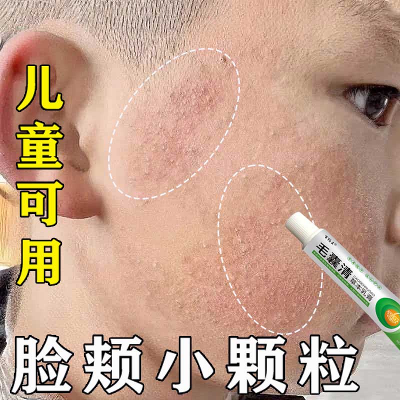 儿童毛周角化症膏去除脸部鸡皮肤脸上有小颗粒脸颊专用毛囊角质膏