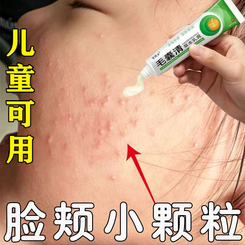 儿童毛周角化症膏去除脸部鸡皮肤脸上有小颗粒脸颊专用毛囊角质膏