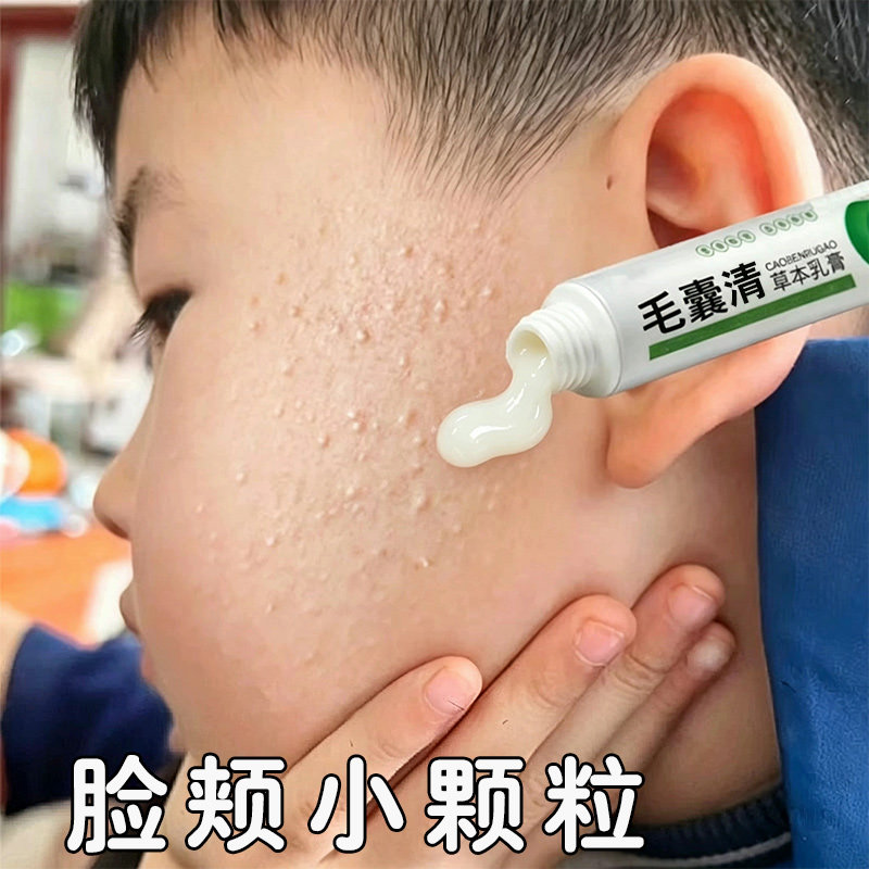 儿童毛周角化症膏去除脸部鸡皮肤脸上有小颗粒脸颊专用毛囊角质膏