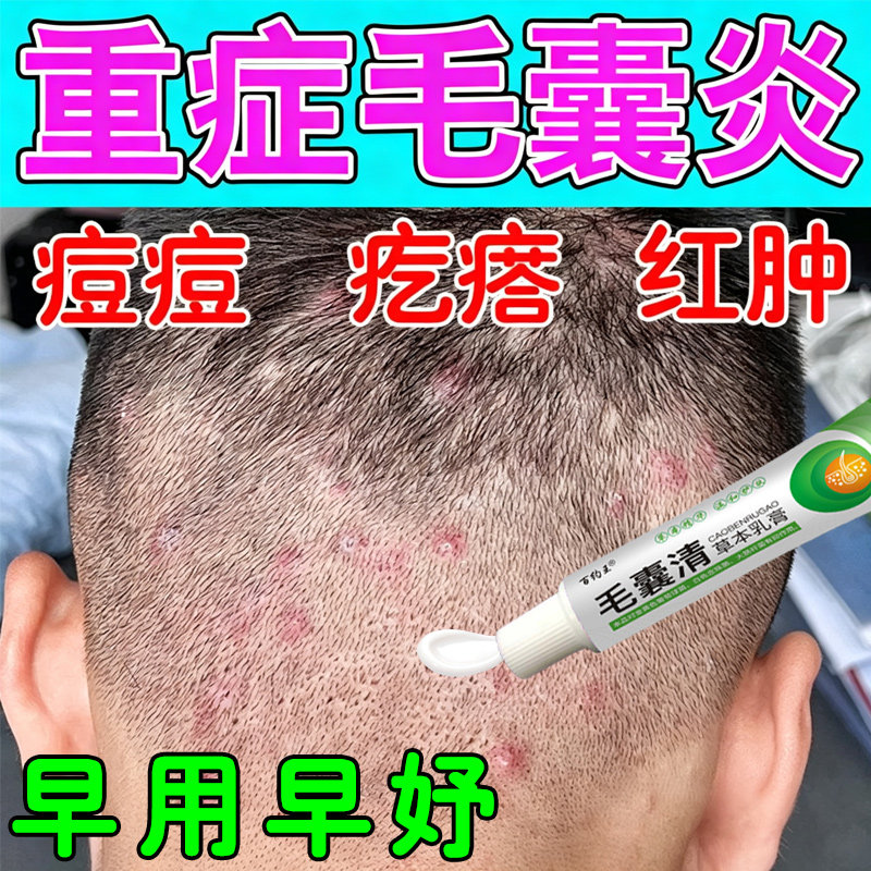 头皮毛囊焱专用膏头部脖子前胸后背私处长痘痘痒溢脂性毛囊藓乳膏