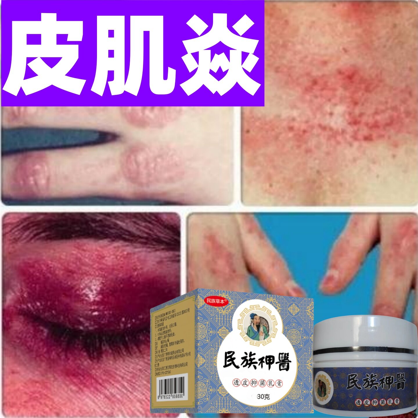 治皮肌炎多发性无肌性肌炎特效药成人儿童紫红色小疙瘩红斑药膏