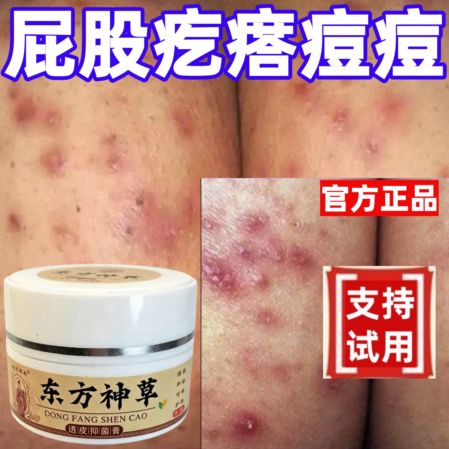 屁股疙瘩痘痘久坐捂热越挠越痒股屁眼瘙痒消除止痒抑菌膏