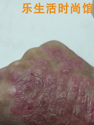 皮肤病牛皮癣芙必康步步止痒药膏原神锐苗方步步止痒药膏皮肤外用