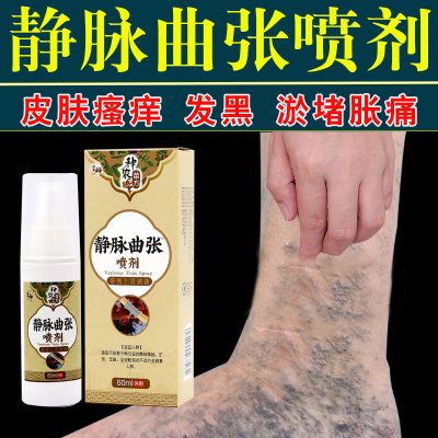 静脉曲张皮肤发黑瘙痒促血液循环