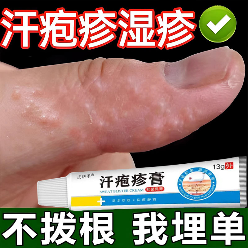 汗泡药膏手上起小水泡手痒汗状止痒汉状真菌感染专用软膏