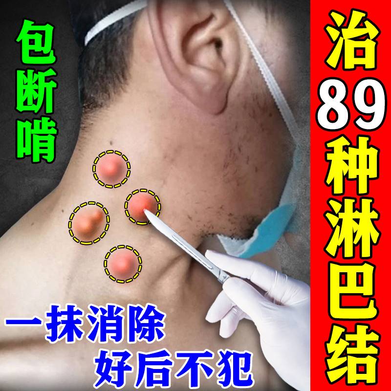 治淋巴结消散膏颈部腋窝疼痛淋巴结疏通耳后淋巴硬块肿大散结贴膏