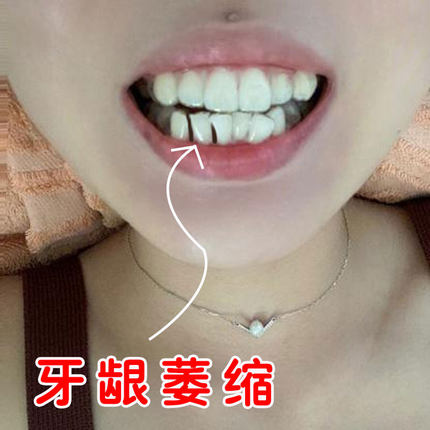 牙龈萎缩修复再生专用药牙龈上火肿痛出血牙齿松动牙周炎牙根外露