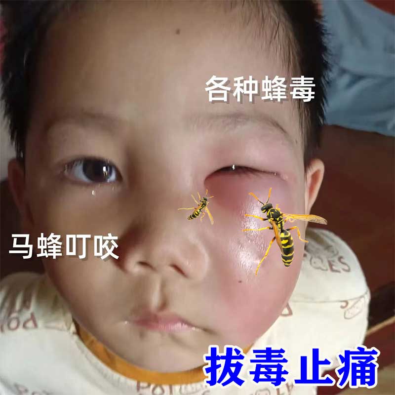 解各种蜂毒被蜂蜇了马蜂蜜蜂叮咬红肿疼痛起泡流脓拔毒止痒止痛药 畜牧/养殖物资 招蜂水/诱蜂蜡 原图主图