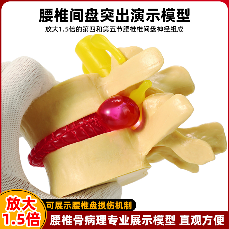 人体放大腰椎间盘挤压演示模型
