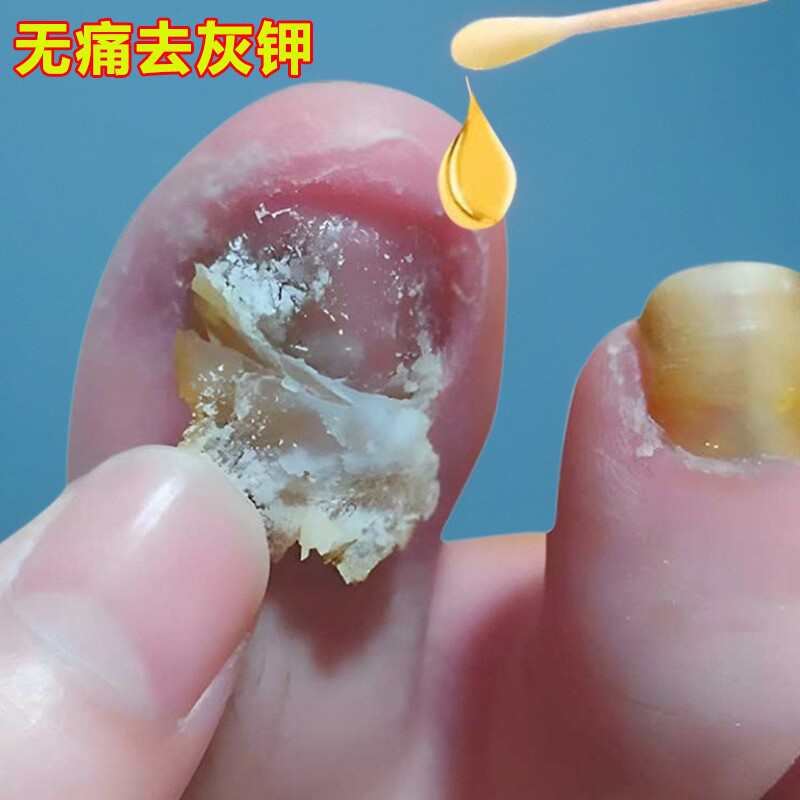 【专祛灰钾】一滴祛除脚趾灰钾专用祛除99%灰钾真菌灰指钾专用药