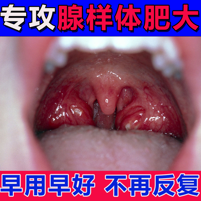 腺样体肥大面容矫正器调理儿童嘴唇上翘中药贴腺样体面容矫正克星