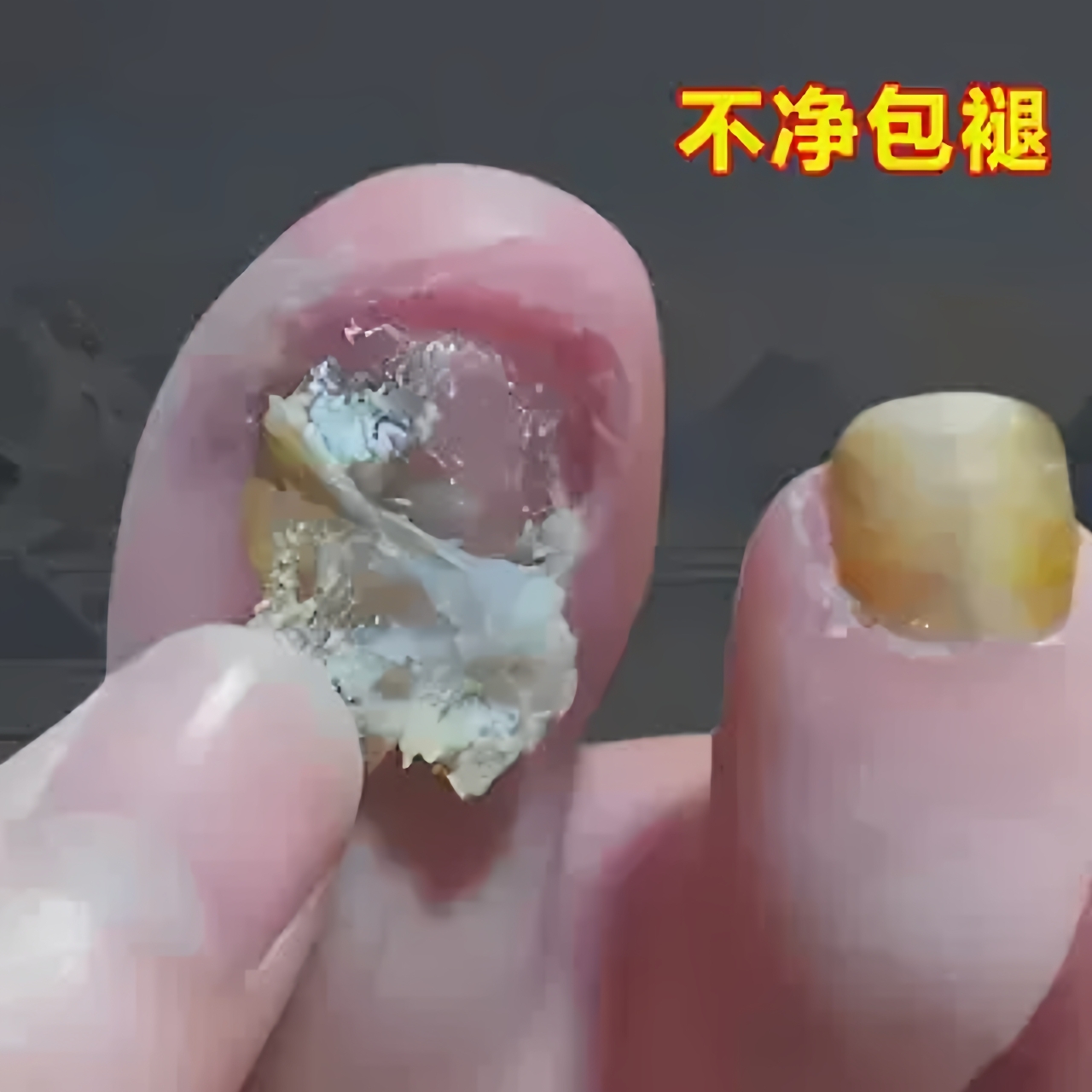 【同仁堂热卖10万+】不包不修 滴一滴无痛去除手脚趾坏钾不伤好钾