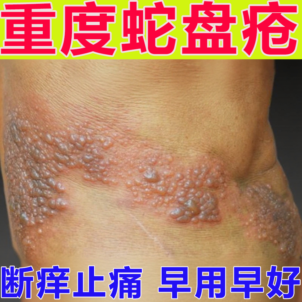 蛇盘疮专用膏药蛇缠腰蛇胆疮带状疹疱克星后遗症神经痛疼外用