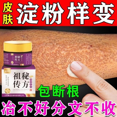 皮肤淀粉样变专用药治疗顽固性苔藓斑状蛋白沉积止瘙痒膏去除颗粒