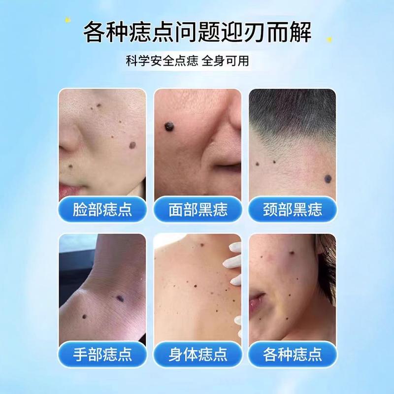 日本点斑去痣点痣膏脸部专用除黑痣祛痣神器无痕正品美容院点痣水