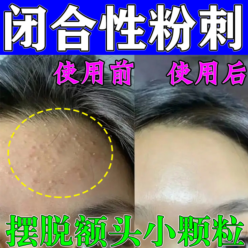 治额头逆光疹儿童脸上起小疙瘩粉刺痘星痒克痒祛外用特效软膏