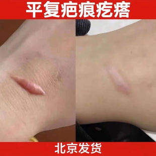 北京黑布疤痕膏胸口疙瘩凸起软化顽固增生平复脸上增生北京发货