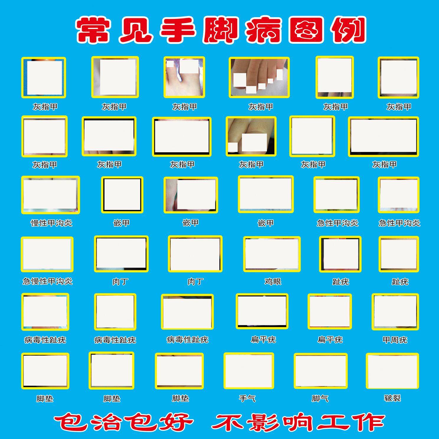 常见手脚病图例背景墙海报制作定制喷绘广告墙贴KT板专业修脚