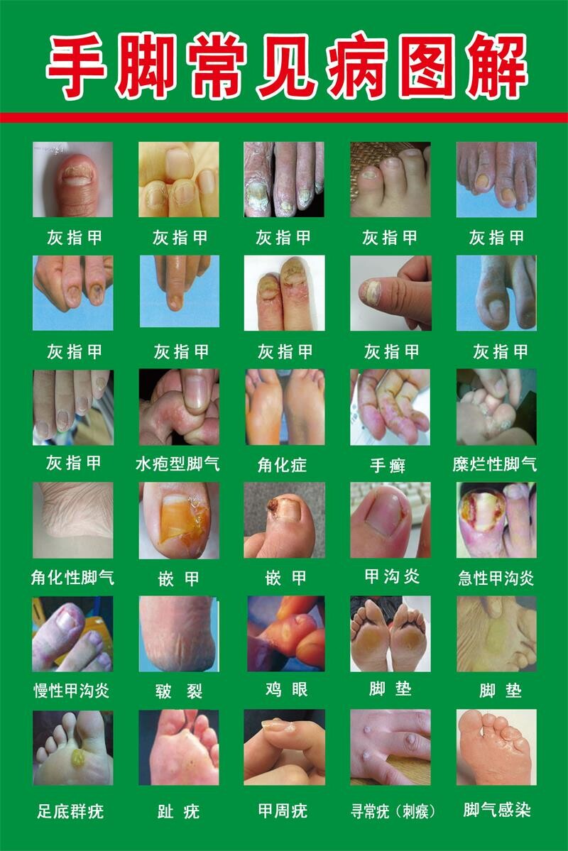 手脚常见病图解治疗修复灰指甲海报脚病图灰指甲店装饰画广告自粘