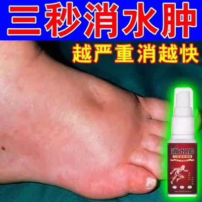 秋冬水肿】脚肿消肿利尿排水肿神器治疗去老人小腿部下肢浮肿喷剂