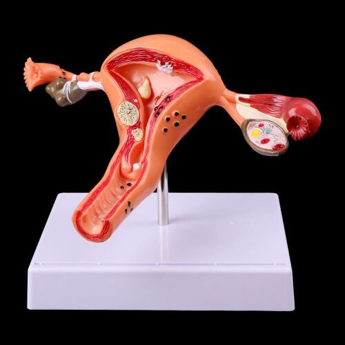 Medical props model Free postage Pathological Uterus Ovary A